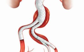 stentgrafty-tetniak-aorty