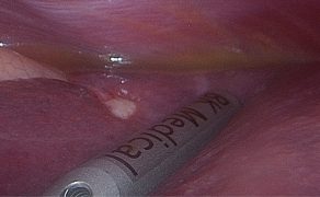OPM_5_19_wspolczesne-techniki-laparoskopowe