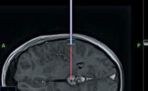 OPM_1_20_neuronawigacja-mozgu-technologia