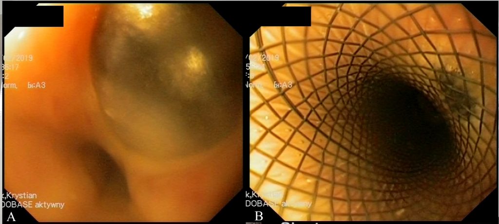 OPM_3_22_Krystian_Zuk_Jacek_Pawlak_ENDOSKOPIA_UKLADU_POKARMOWEGO_FOT_10